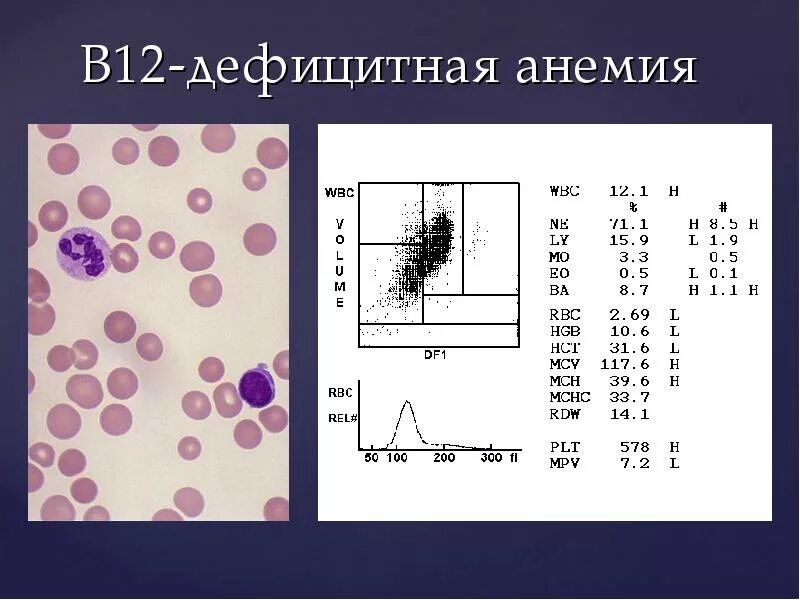 Б12 анемия анализ крови показатели. ОАК при b12 анемии. B12 дефицитная анемия гемограмма. Показатели крови при в12 дефицитной анемии. Б 12 исследования