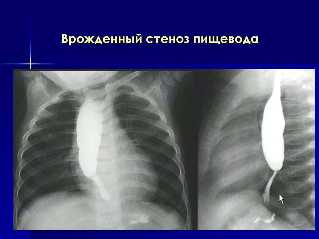 Стриктура пищевода рентген. Врожденный короткий пищевод рентген. Врожденный стеноз пищевода.