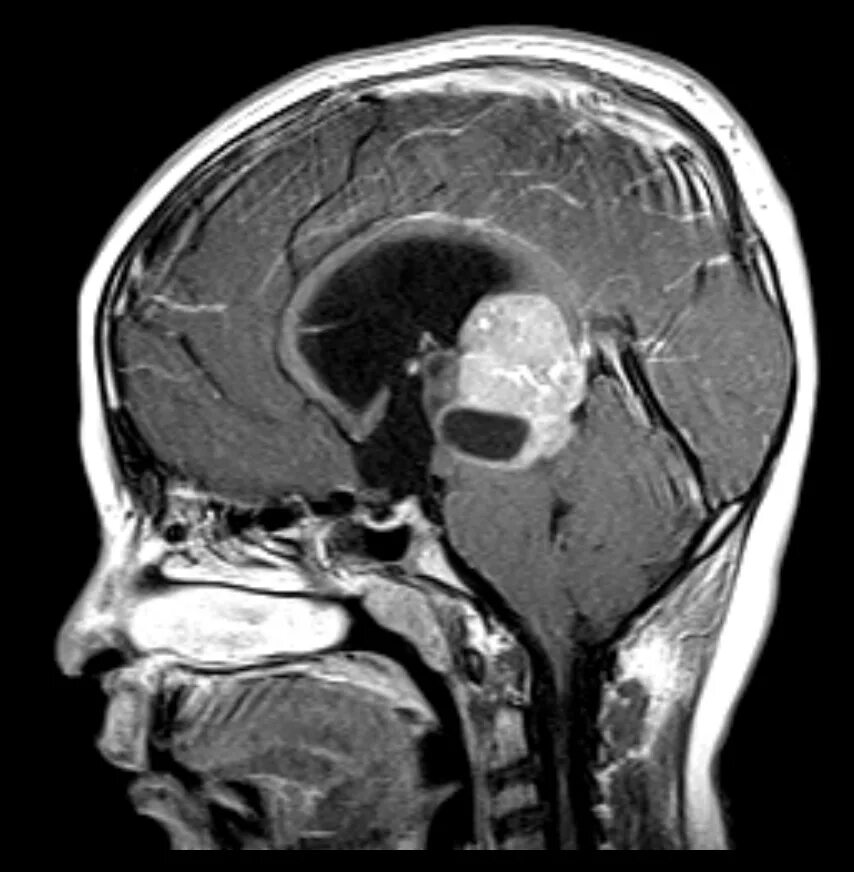 Герминома шишковидной железы мрт. Пинеалома опухоль шишковидной железы. Киста пинеальной области. Герминома