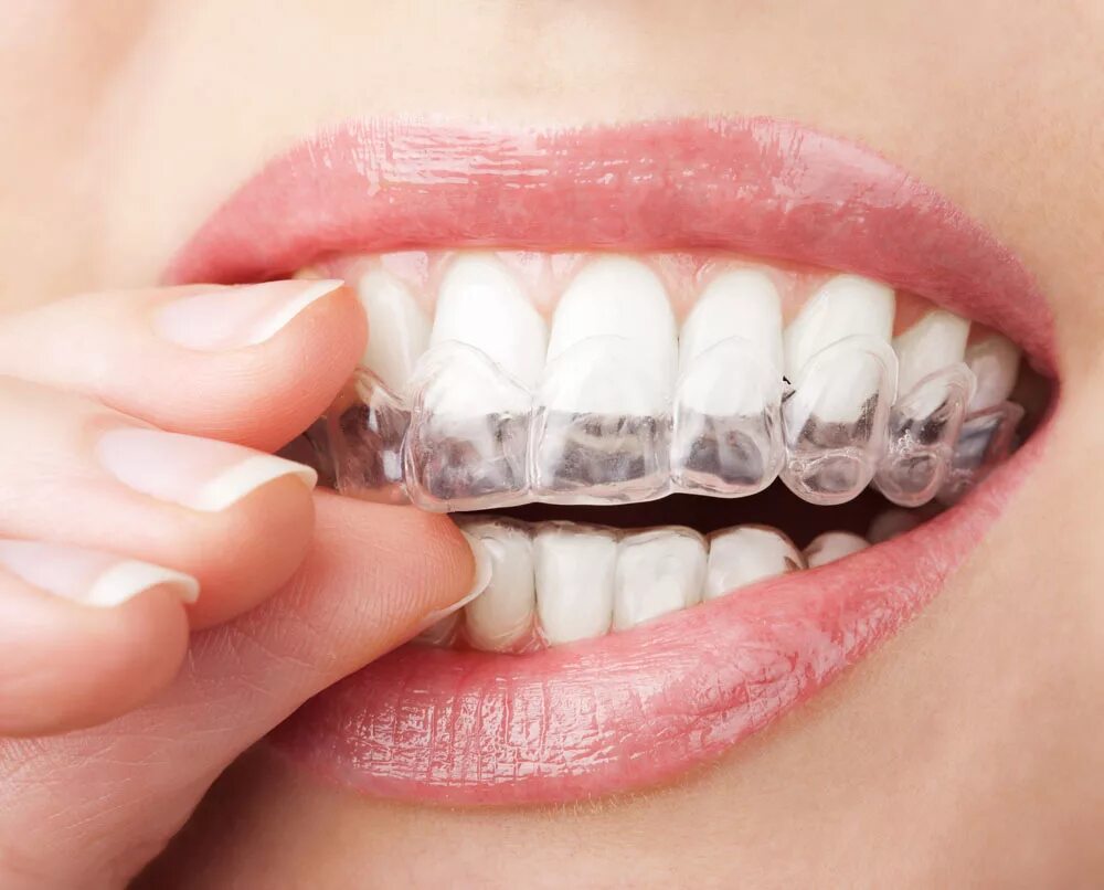 Как выглядят капы. Каппы Инвизилайн. Элайнеры Invisalign. Капа Инвизилайн ортодонтическая.