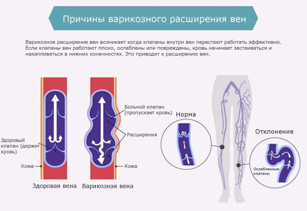 Варикозное расширение вен нижних конечностей причины. Варикозная болезнь вен нижних конечностей факторы. Буклет варикозное расширение вен нижних конечностей. Варикозная болезнь расширение вен факторы. Профилактика варикозного расширения нижних конечностей