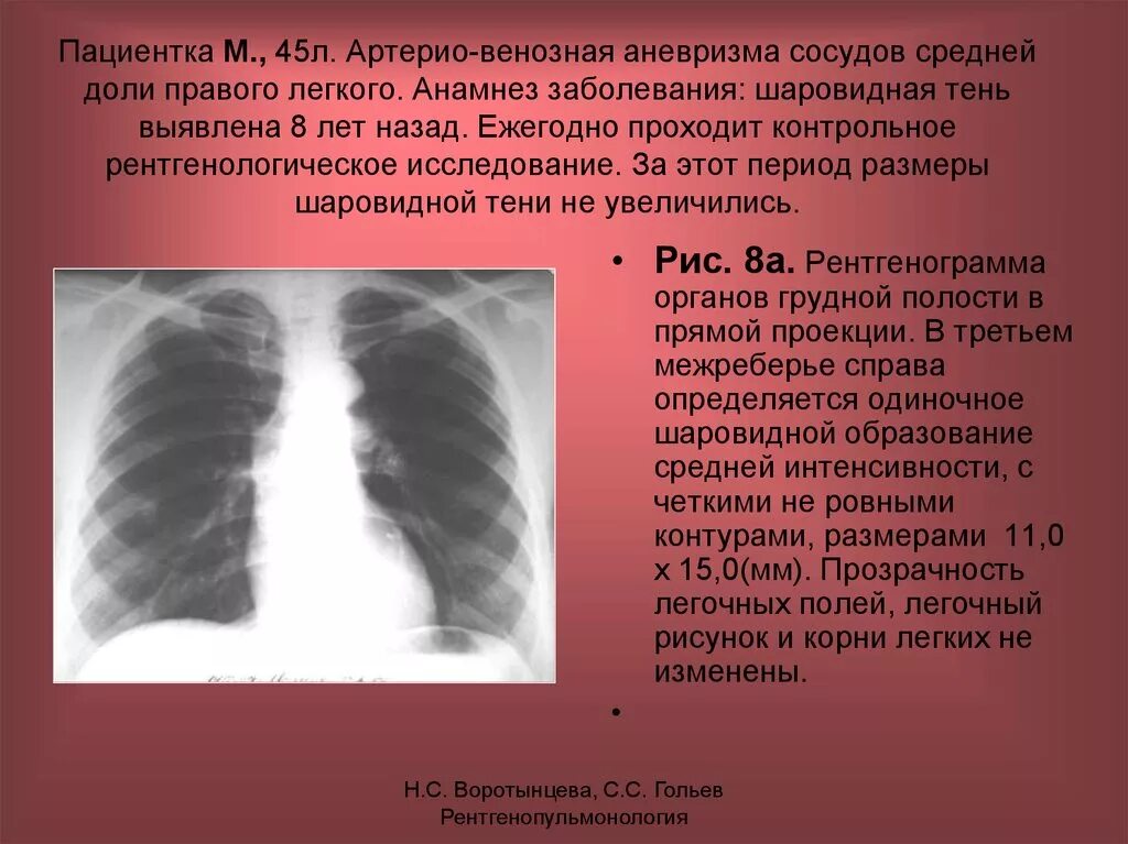 Верхние доли легких тени. Аневризма легочной артерии рентген. Расширение легочной артерии рентген. Аневризма на рентгене легких. Сосудистая аневризма легкого рентген.