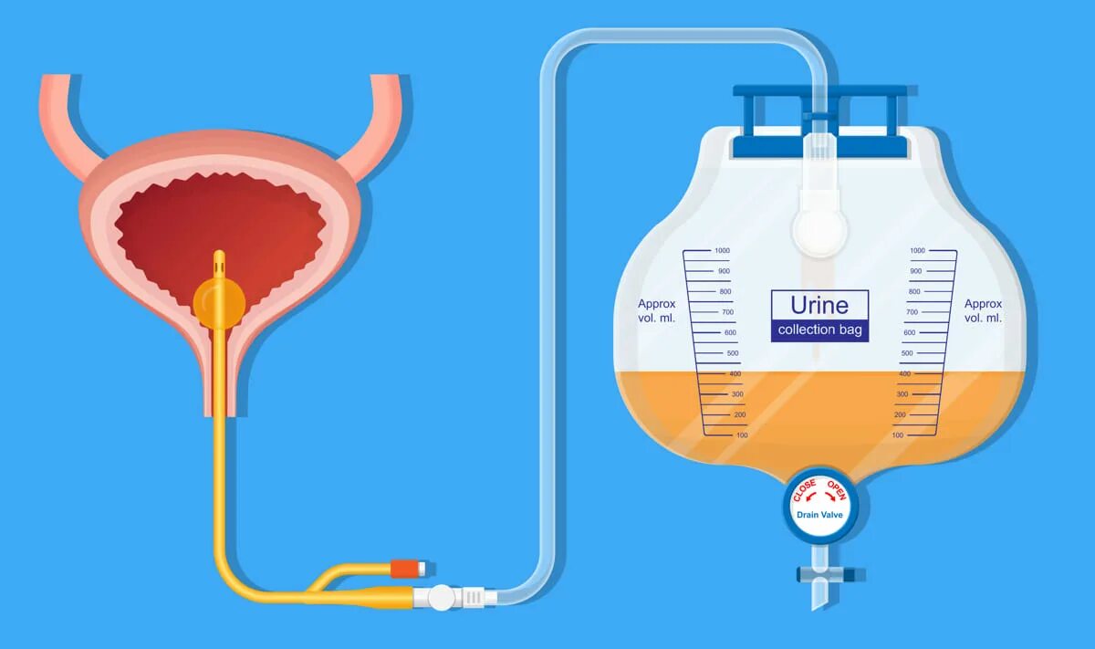 Катетер-ассоциированных инфекций мочевых путей. Катетер для мочеиспускания. При острой задержке мочи. Задержка мочеиспускания - ишурия. Гипотония мочевого пузыря