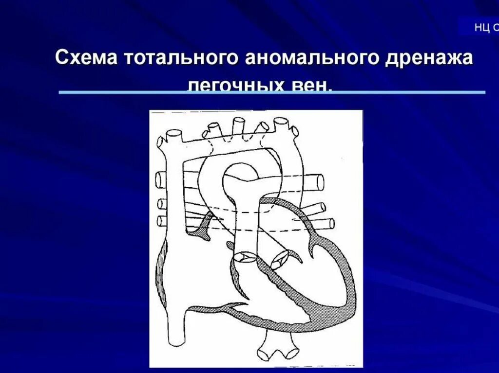 Тотальный аномальный дренаж легочных вен мкб 10. Аномальное впадение легочных вен. Аномальный дренаж. Частичный аномальный дренаж легочных вен эхокардиография. Тотальный аномальный дренаж легочных вен схема.