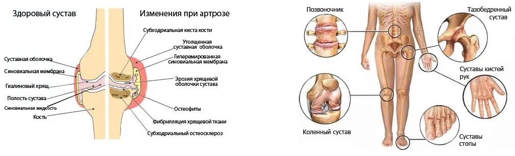 Какие бывают болезни суставов. Ревматоидный артрит классификация коленный сустав. Ревматоидный артрит опухшие суставы. Деформирующий остеоартроз деформация суставов. Ревматоидный артрит локализация поражения суставов.