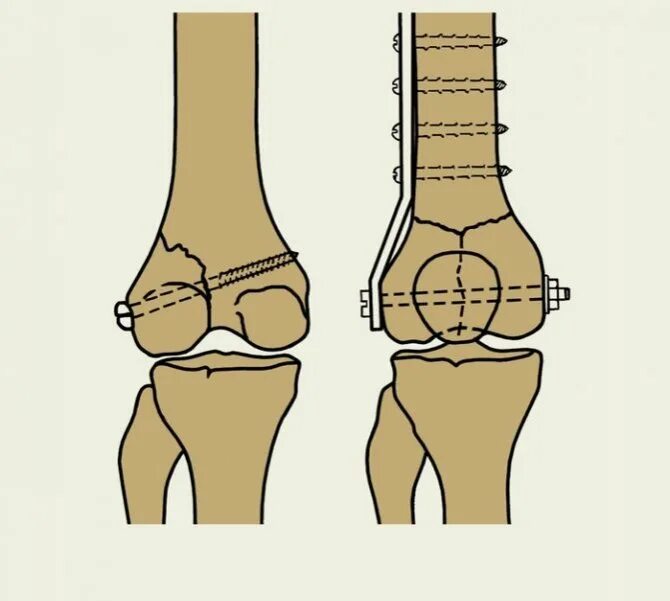 Лечение мыщелка. Перелом мыщелка бедренной кости. Остеосинтез мыщелков бедренной кости. Внесуставной остеосинтез. Перелом мыщелка остеосинтез.