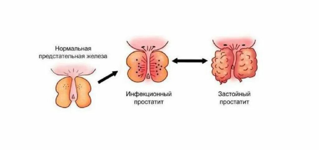 Конгестивный простатит. Классификация простатита. Воспаление предстательной железы. Степени простатита