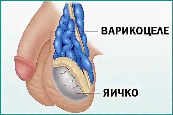 Венозное сплетение яичка. Варикоз вен семенного канатика.