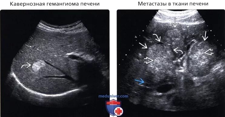 Образование в печени на узи. Множественные гемангиомы печени УЗИ. Очаговые образования в печени на УЗИ. Кавернозная гемангиома печени на УЗИ.