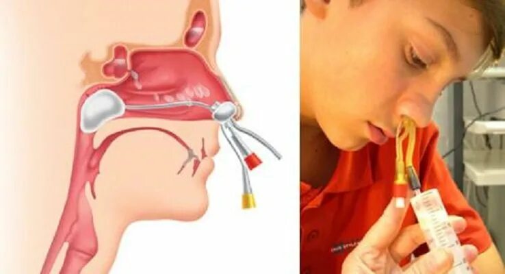 To AVOID A CHILD from Pathological Elevation of Adenoids, it is extremely import