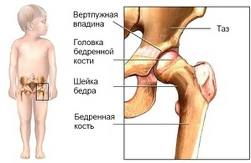 Тазобедренный артрит у ребенка. Антеторсия тазобедренных суставов. Дисплазия вертлужной впадины тазобедренного сустава. Дисплазия тазобедренных суставов 3ст. Эпифизарная дисплазия головки бедренной кости.