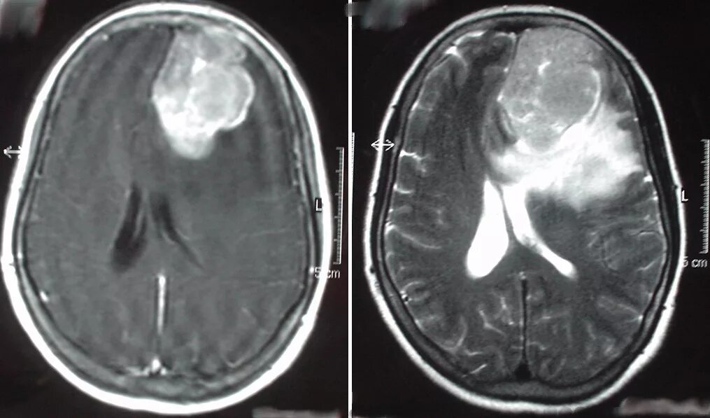 клинические проявления опухоли лобной доли:. клиника, диагностика опухолей затылочной доли. объемное образование в доле правого. кт мрт опухоль лобная доля. глиома лобной доли мрт.