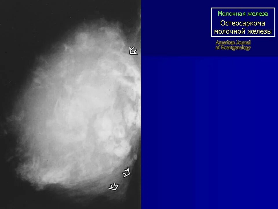 Саркома мкб. Саркома молочной железы на маммографии. Саркома молочной железы на УЗИ. Остеосаркоз молочной железы. Саркома молочной железы фото.