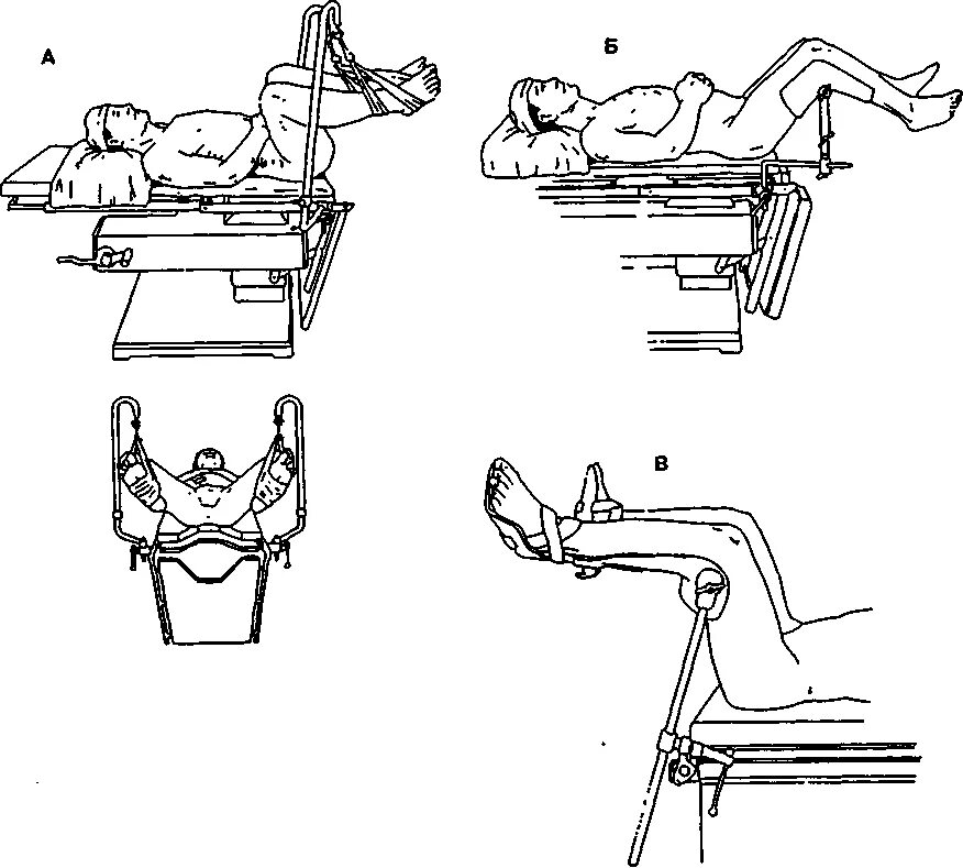 Положение больного на столе. Литотомическое положение / положение Ллойд Дэвис. Литотомическое положение на операционном столе. Литотомическое положение. Гинекологическое кресло.