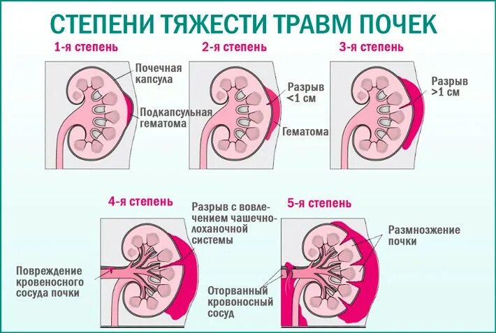 Можно ли удалить почки. Степени повреждения почки. травма почки классификация. 5 степеней повреждения почек.