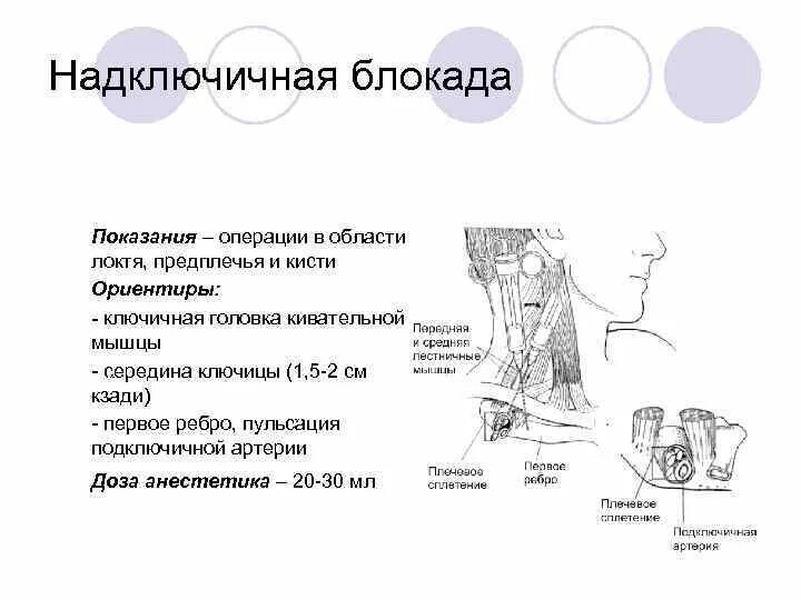 Блокада показания. Блокада кивательной мышцы. Виды блокад и Назначение. Блокада плечевого сплетения надключичным доступом.