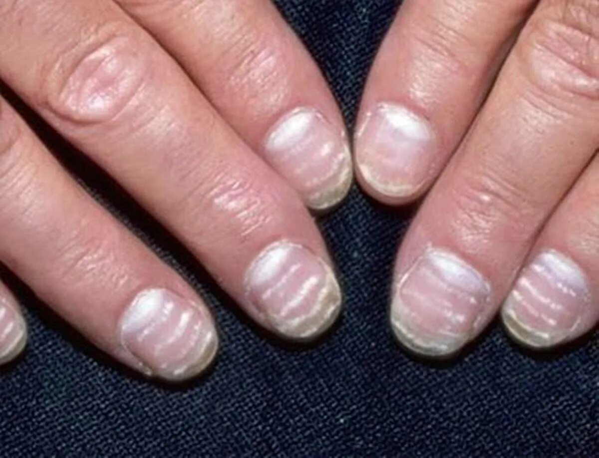 Что значат полосы на ногтях. Микотическая лейконихия. Лейконихия (белые пятнышки). Псориатическая лейконихия.