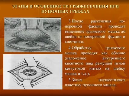Пупочная грыжа методы операции