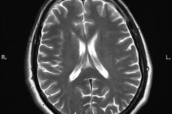 Патологии на мрт. Ликворография головного мозга магнитно-резонансная. Атрофия головного мозга мрт. Atrophy головного мозга мрт. Снимок здорового мозга.