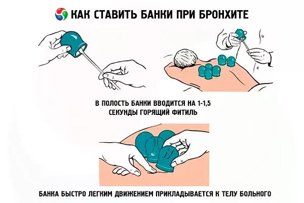 Действие банок. Как правильно поставить банки на спину. Постановка банок на спину при кашле. Схема постановки банок стеклянных на спину. Схема постановки медицинских банок.