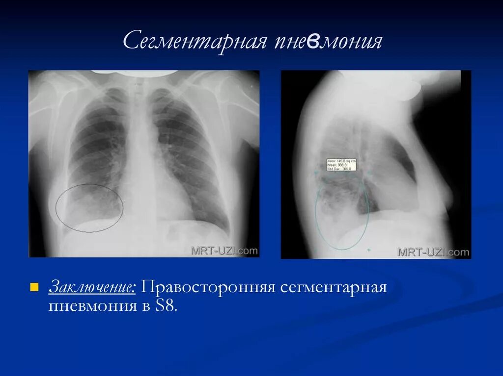 Сегментарная пневмония рентгенограмма. Сегментарная левосторонняя пневмония на рентгене. Левосторонняя полисегментарная пневмония рентген. Правосторонняя нижнедолевая пневмония 10 сегмент. Пневмония в нижней доле правого легкого