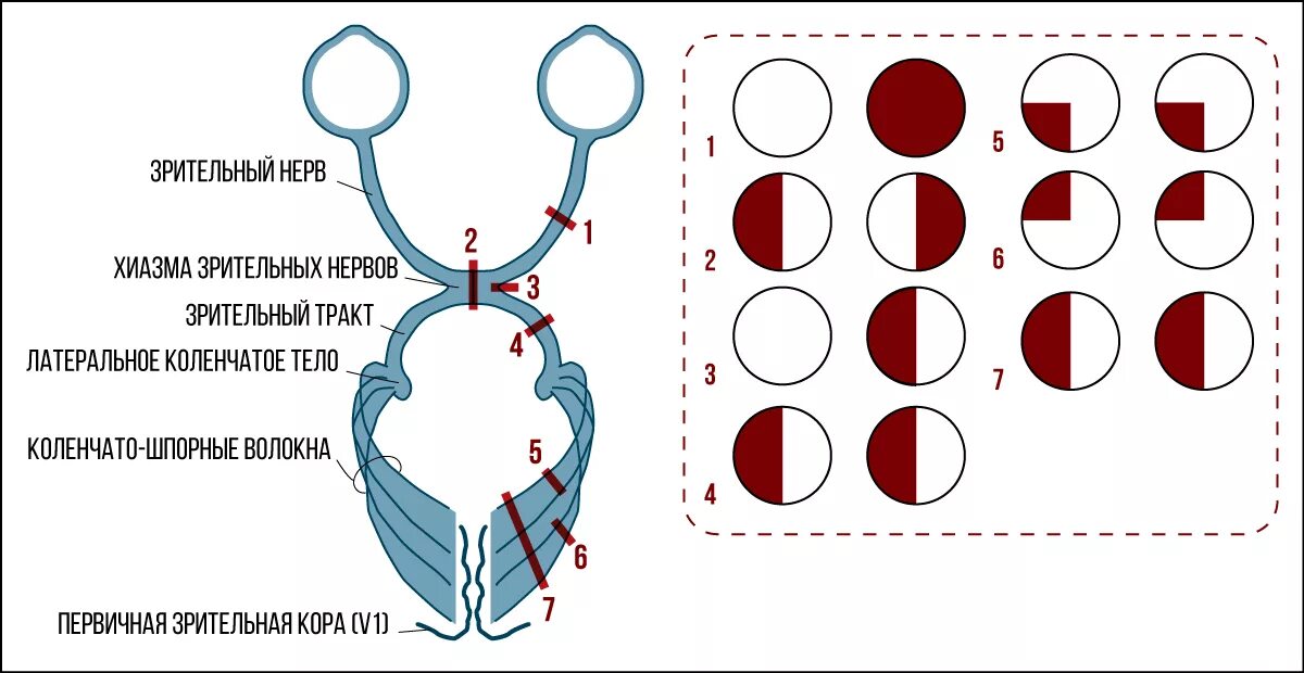 Монимен. Уровни поражения зрительного тракта. Перекрест волокон зрительного нерва. Выпадение полей зрения неврология. Зрительный нерв неврология схема.