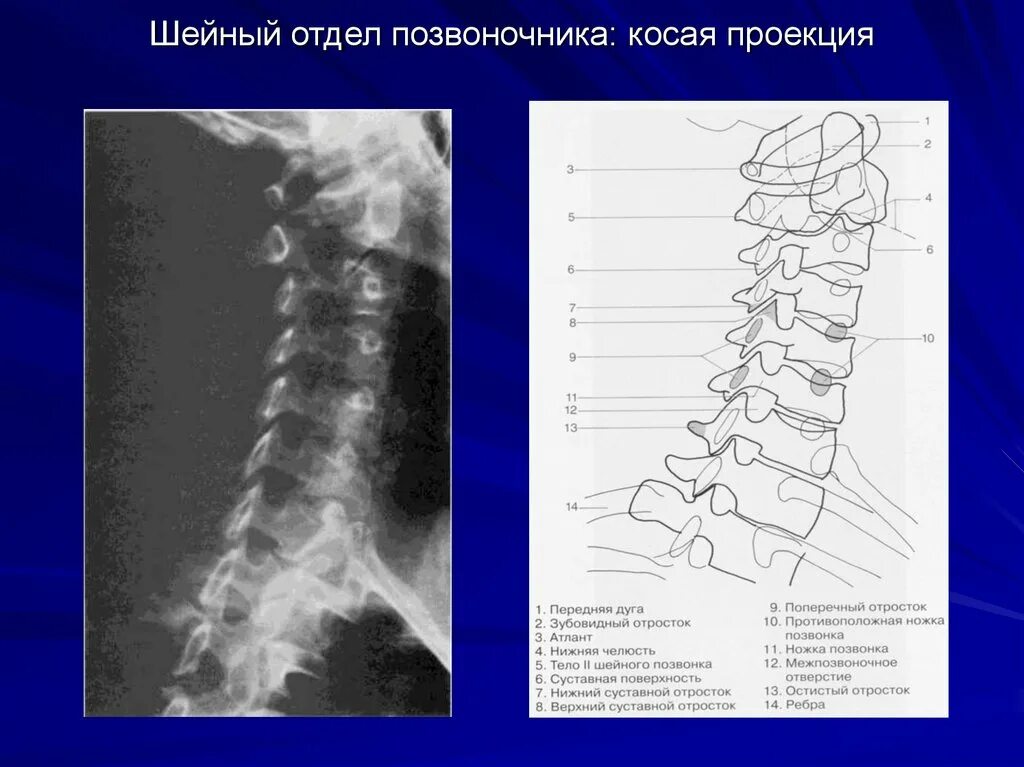 Тело позвонка шейного. Анатомия шейных позвонков рентген. Шейный отдел позвоночника рентген с1-с2.