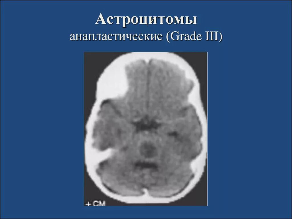 Астроцитома головного мозга прогноз. Анапластическая астроцитома Grade 3 головного мозга. Анапластическая астроцитома мозжечка кт. Анапластическая злокачественная астроцитома гистология. Анапластическая астроцитома мрт.