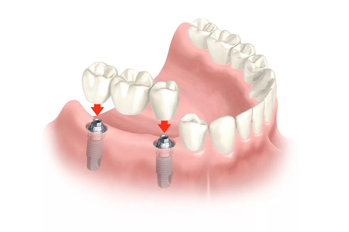 Имплантация neodent. Закрепить зубы. Корневидные имплантаты. Имплант штрауман tissue формирователь. Закрепить зубы.