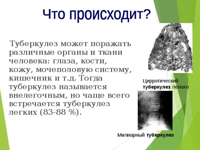 Туберкулез причины возникновения. Старые названия туберкулеза. Туберкулез чего бывает. ТВС туберкулез расшифровка.