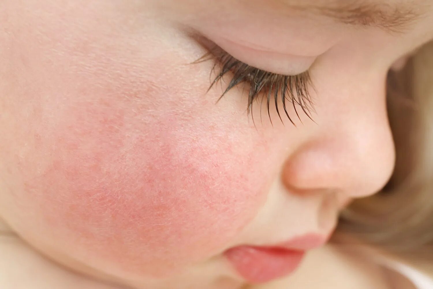 Сыпь на щечках у ребенка пищевая аллергия. Побочные реакции у детей у детей