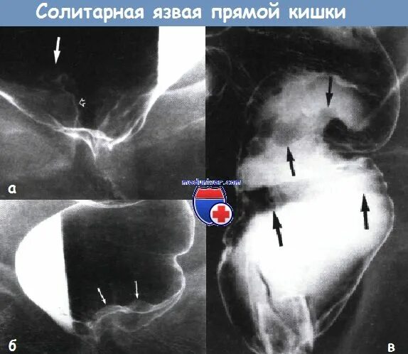 Опущение прямой кишки симптомы. Пролапс прямой кишки пролапс прямой кишки. солитарная язва прямой кишки.