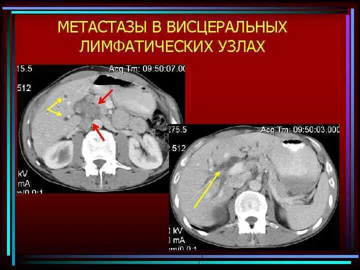 Лучевая терапия метастазов в лимфоузлах. Висцеральные метастазы. лучевая диагностика матки. алгоритмы лучевой диагностики трофимова. лучевая диагностика авм.