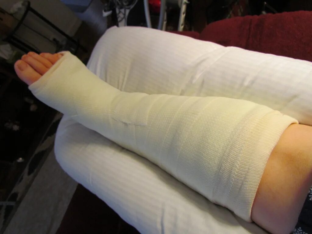 Premium Photo X-ray Knee Joint Fracture proximal tibia and Post fix fracture pro