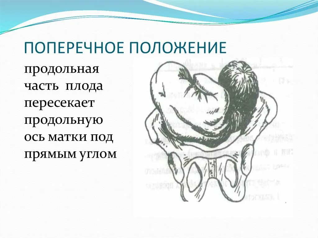 Позиция плода в акушерстве. Косое положение плода позиция. Продольное и поперечное положение. Продольное поперечное косое положение плода. Поперечное положение плода вид позиция.