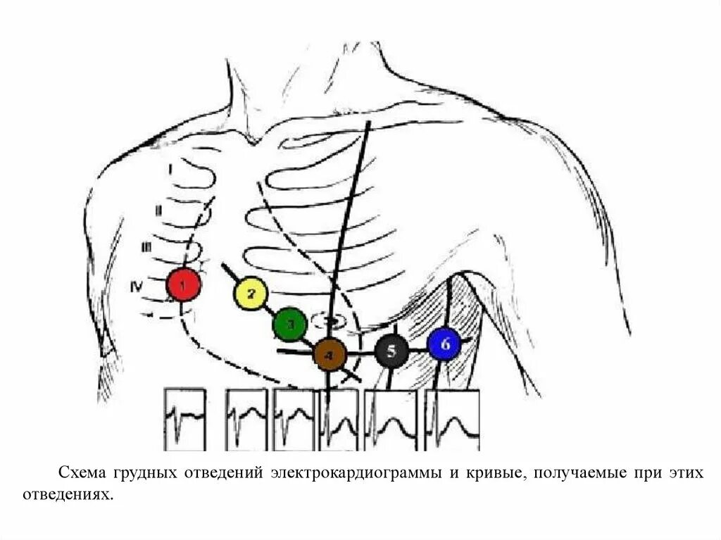 Наложение электродов грудные отведения ЭКГ. Электроды ЭКГ схема наложения электродов. ЭКГ точки наложения грудных электродов. Схема грудных электродов ЭКГ. Соп экг