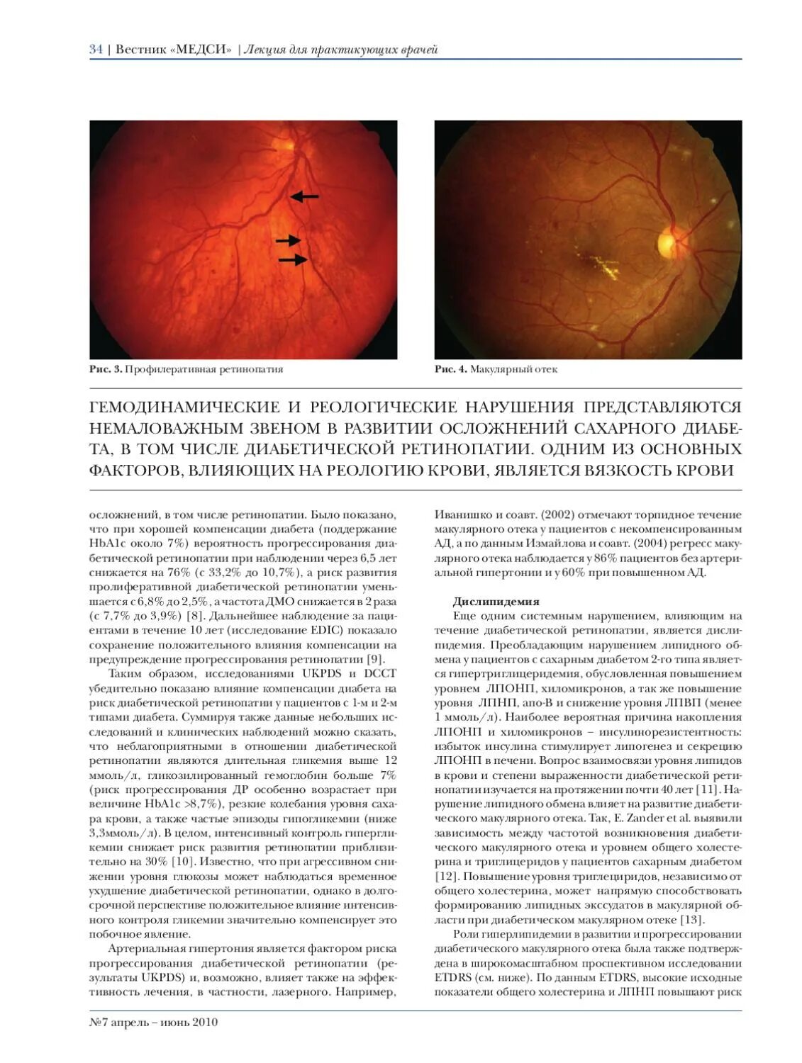 Макулярный отек лечение. Отек при диабетической ретинопатии. Диабетический макулярный отек (ДМО). Диабетическая ретинопатия факторы риска и прогрессирования.