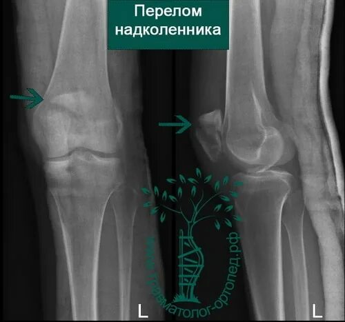 Переломы надколенника травматология. Перелом надколенника снимок. Перелом коленной чашечки операция. Перелом вывих надколенника. Перелом надколенника операции