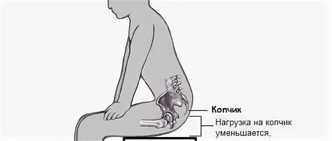 Ушиб копчика симптомы