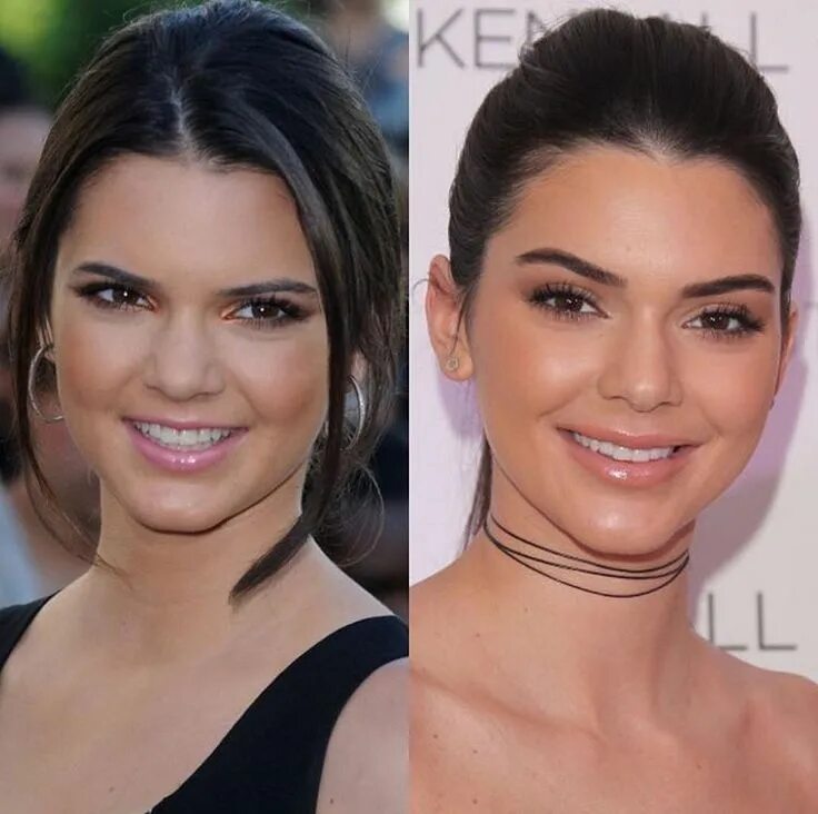 Кендалл дженнер до операции и после Kendall Jenner Looks Back at Her 'Ugly' Preteen Years