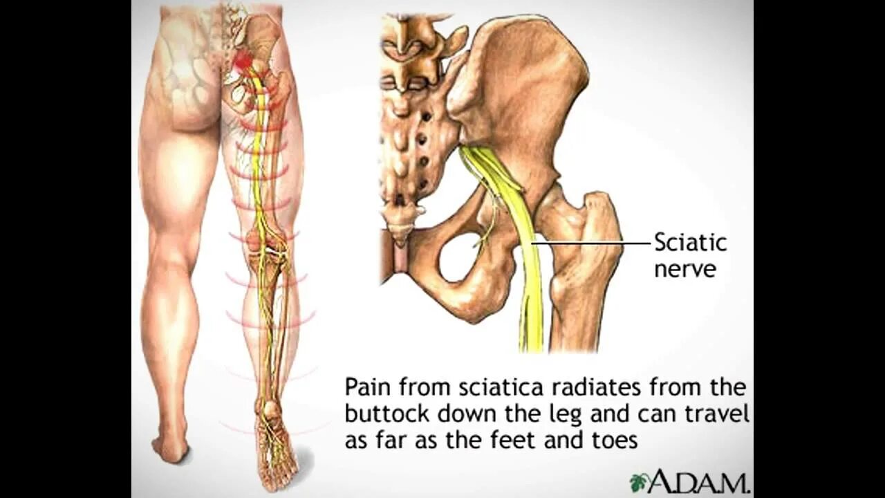 Ноет нога в ягодице. Ишиас седалищного нерва симптомы. При защемлении седалищного нерва. Защемило седалищный нерв. Защемило седалищный нерв симптомы упражнения.
