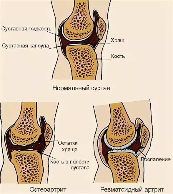 Типы артритов