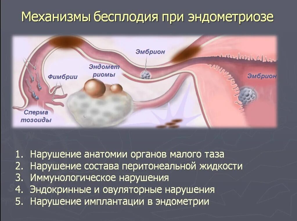 Эндометриоз и бесплодие. Маточное бесплодие