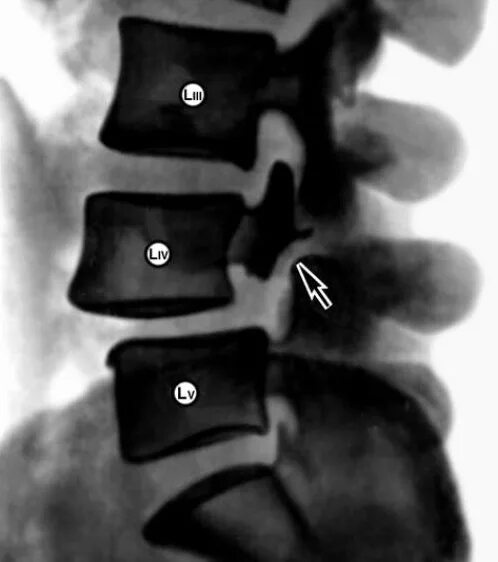 Ретролистез l5 позвонка 4 мм. Ретролистез l5 позвонка рентген. Спондилолистез l2 позвонка. Спондилолистез 1. Спондилолистез l4 позвонка что это такое.