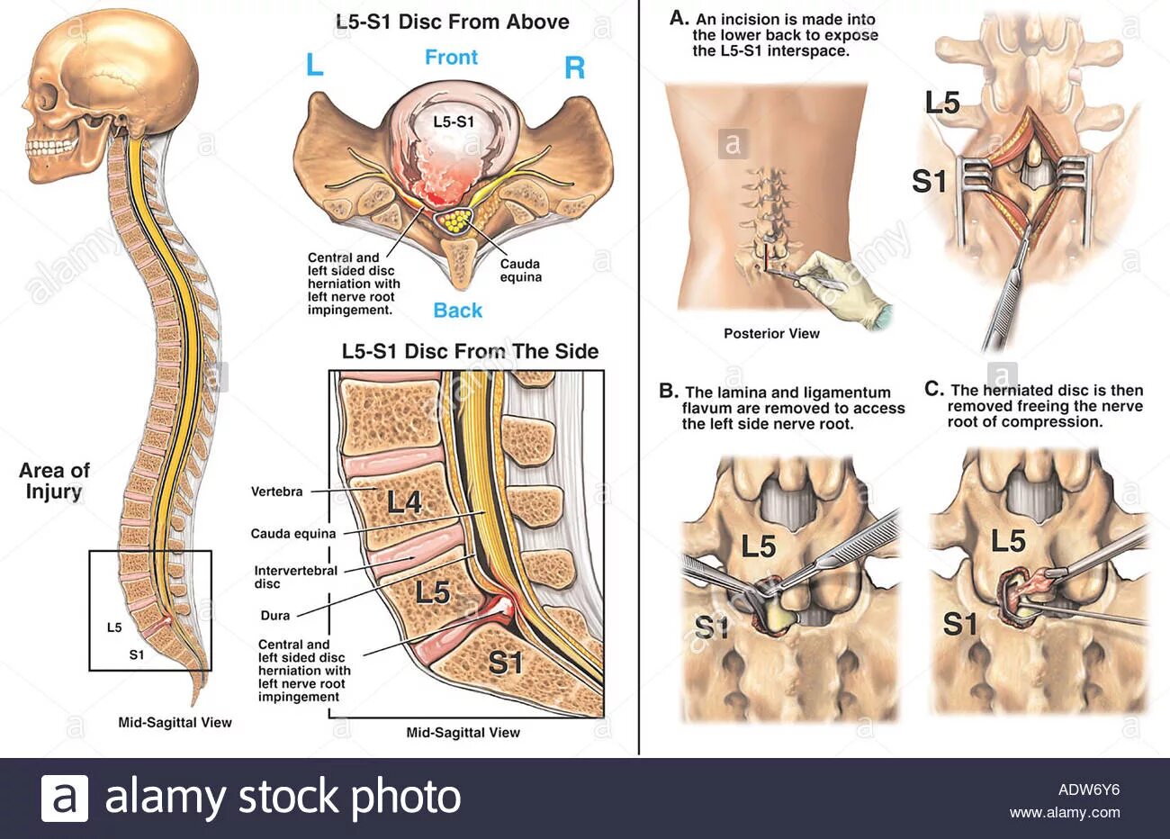 Диск l1-l2 позвоночника. Протрузия межпозвоночных дисков l4 s1. Межпозвонковый диск l5-s1. Сегменты позвоночника l5 s1. Протрузия дисков l3-l4.