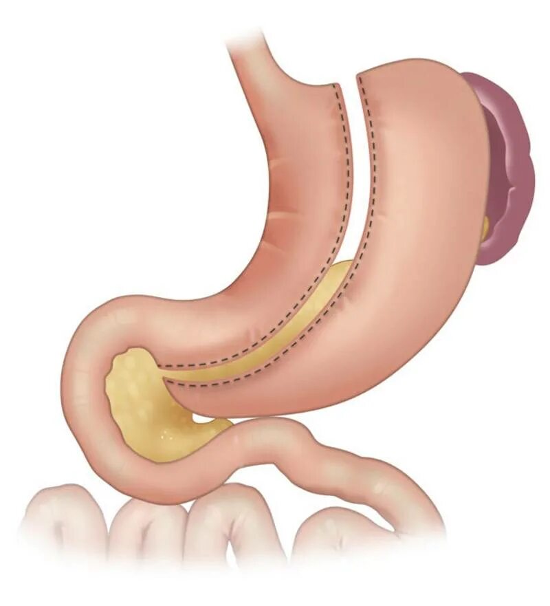 Бариатрическая операция резекция. Продольная резекция желудка _sleeve gastrectomy. бариатрическая операция продольная резекция желудка. операция рукавная гастропластика.