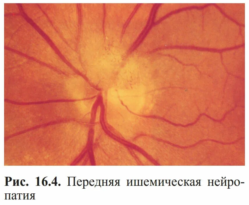 Передняя ишемическая невропатия зрительного нерва. Ишемическая нейропатия глазное дно. Ишемическая нейропатия зрительного нерва. Ишемическая оптикопатия зрительного нерва. Нейропатия глаза