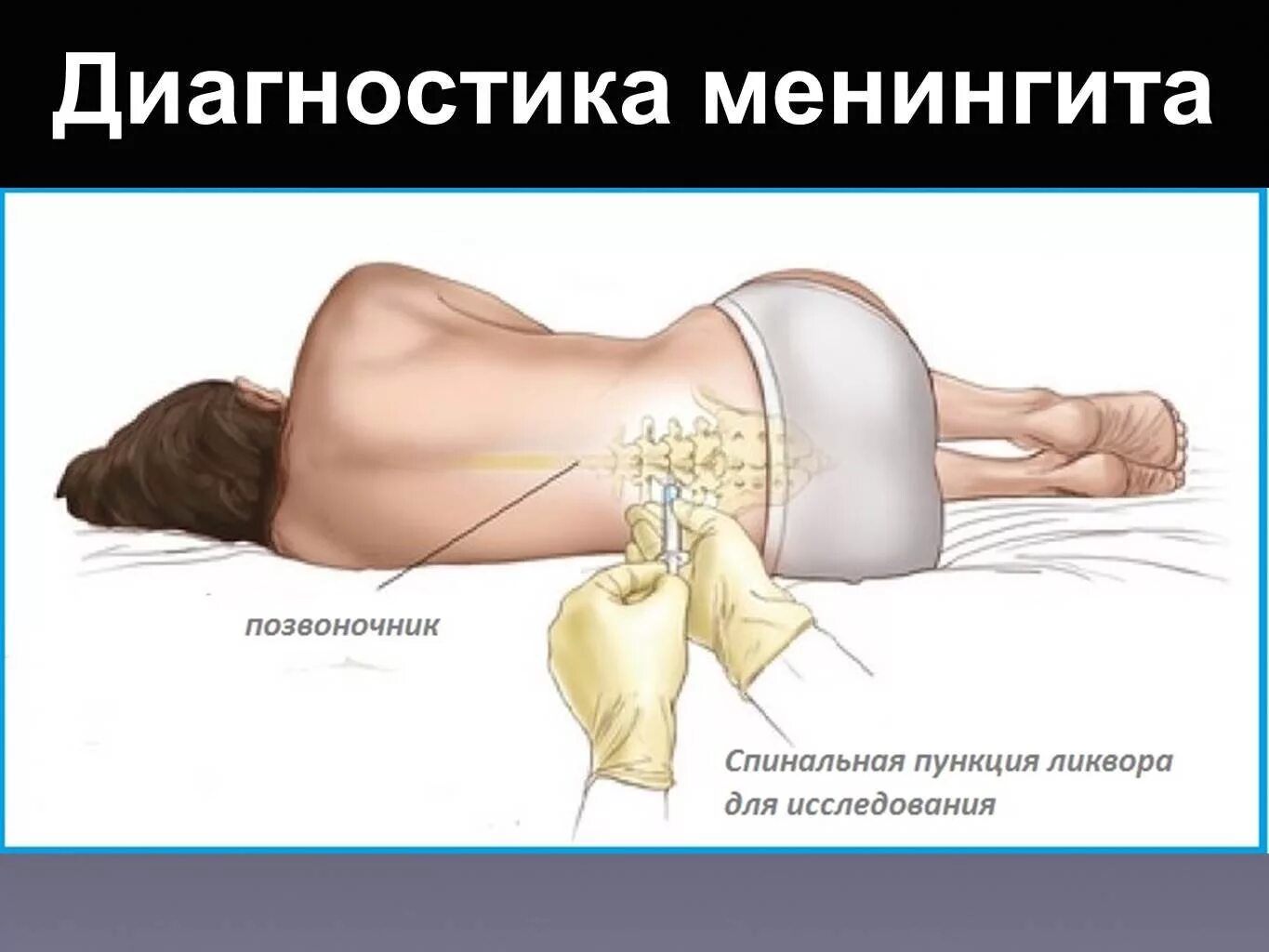 Люмбальная пункция менингит диагностика. Менингит люмбальная пункция у детей. Люмбальная пункция при менингите ликвор. Пункция для выявления менингита. Осложнения после пункции