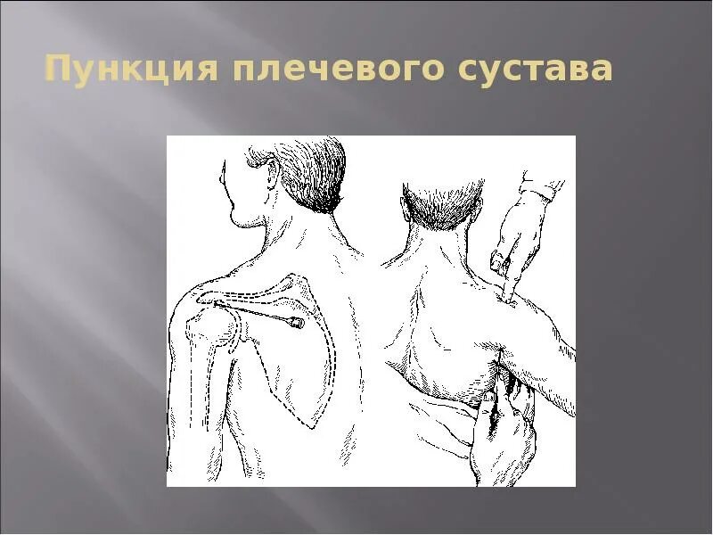 Пункция сустава техника выполнения. Пункция плечевого сустава топографическая анатомия. Пункция и артротомия плечевого. Плечевая латеральная пункция. Артротомия плечевого сустава топографическая анатомия.