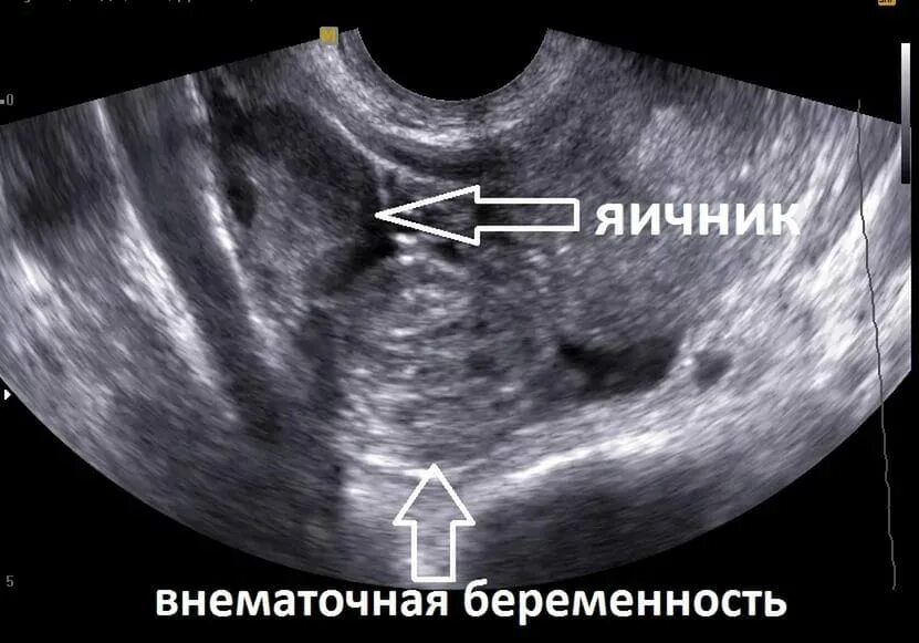 Почему не видно эмбрион. Внематочная Трубная беременность УЗИ. Маточная и внематочная беременность УЗИ. Внематочная беременность на УЗИ. Внематочная беременность 5-6 недель УЗИ.